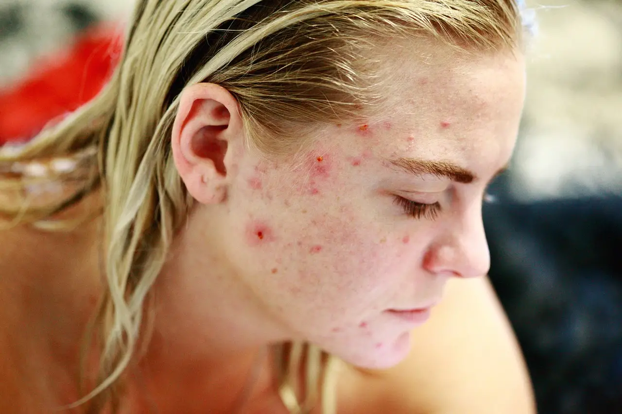 Understand acne types, causes, and treatment