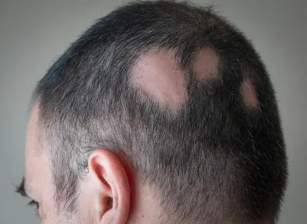 Alopecia Areata Doctor