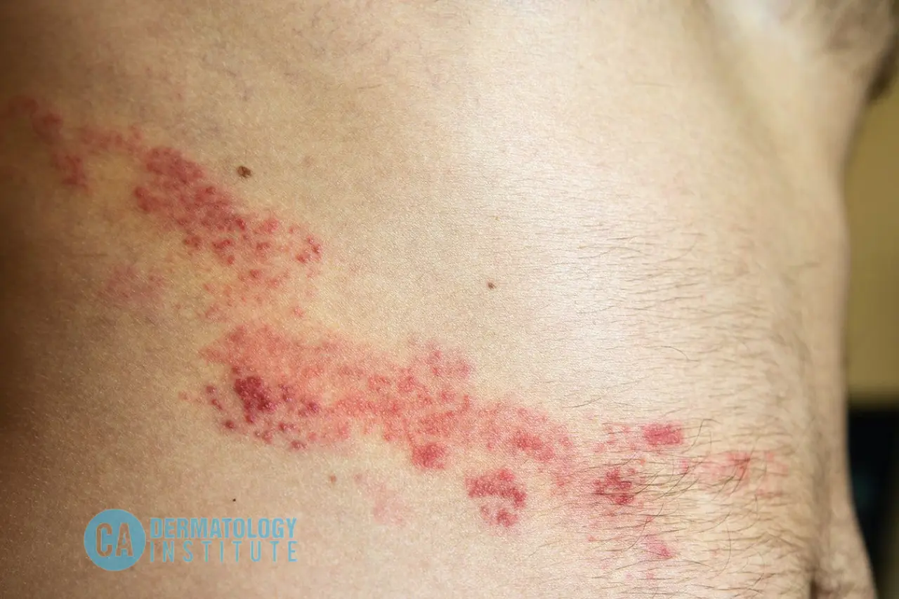 Should I See a Dermatologist for Shingles?
