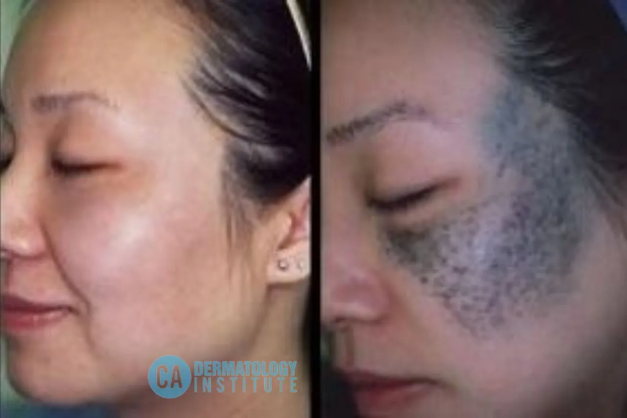 How Can You Remove Birthmarks from Face?