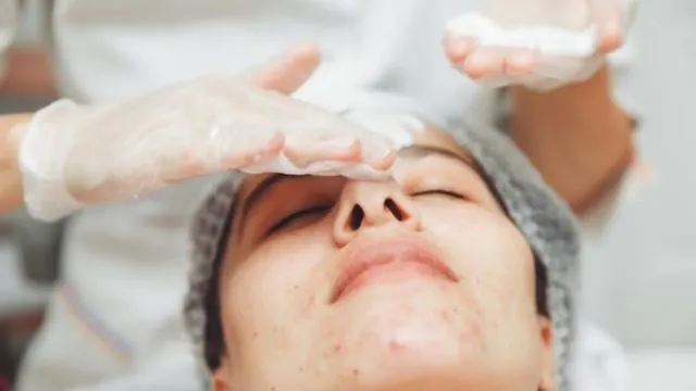 The Ultimate Guide to Using Chemical Peels for Dark Spots