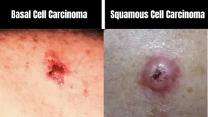 How Is Basal Cell Different from Squamous Cell Carcinoma?