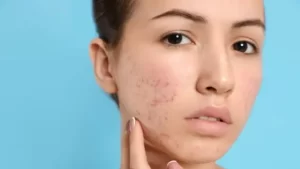 Should I Go to a Dermatologist for Acne?