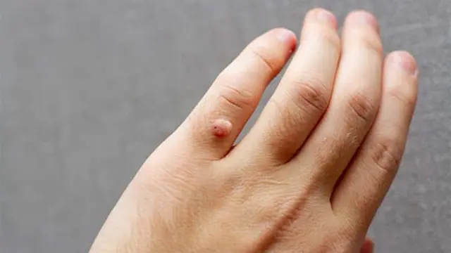 Wart Removal Treatment at a Dermatologist