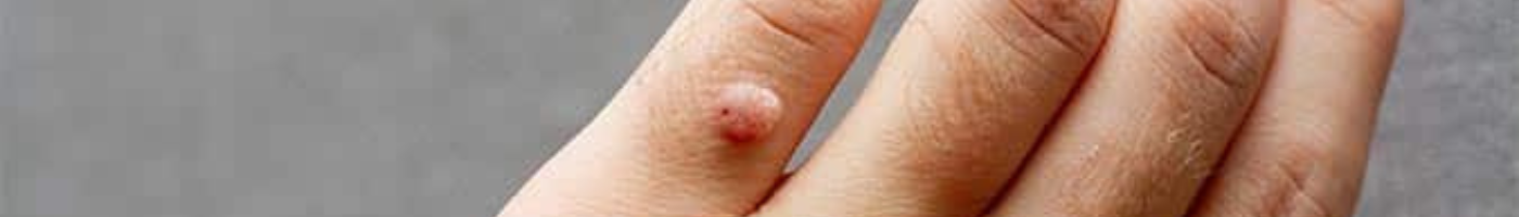 Wart Removal Treatment